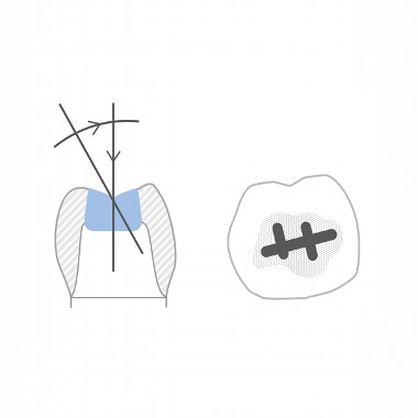 burs dental51
